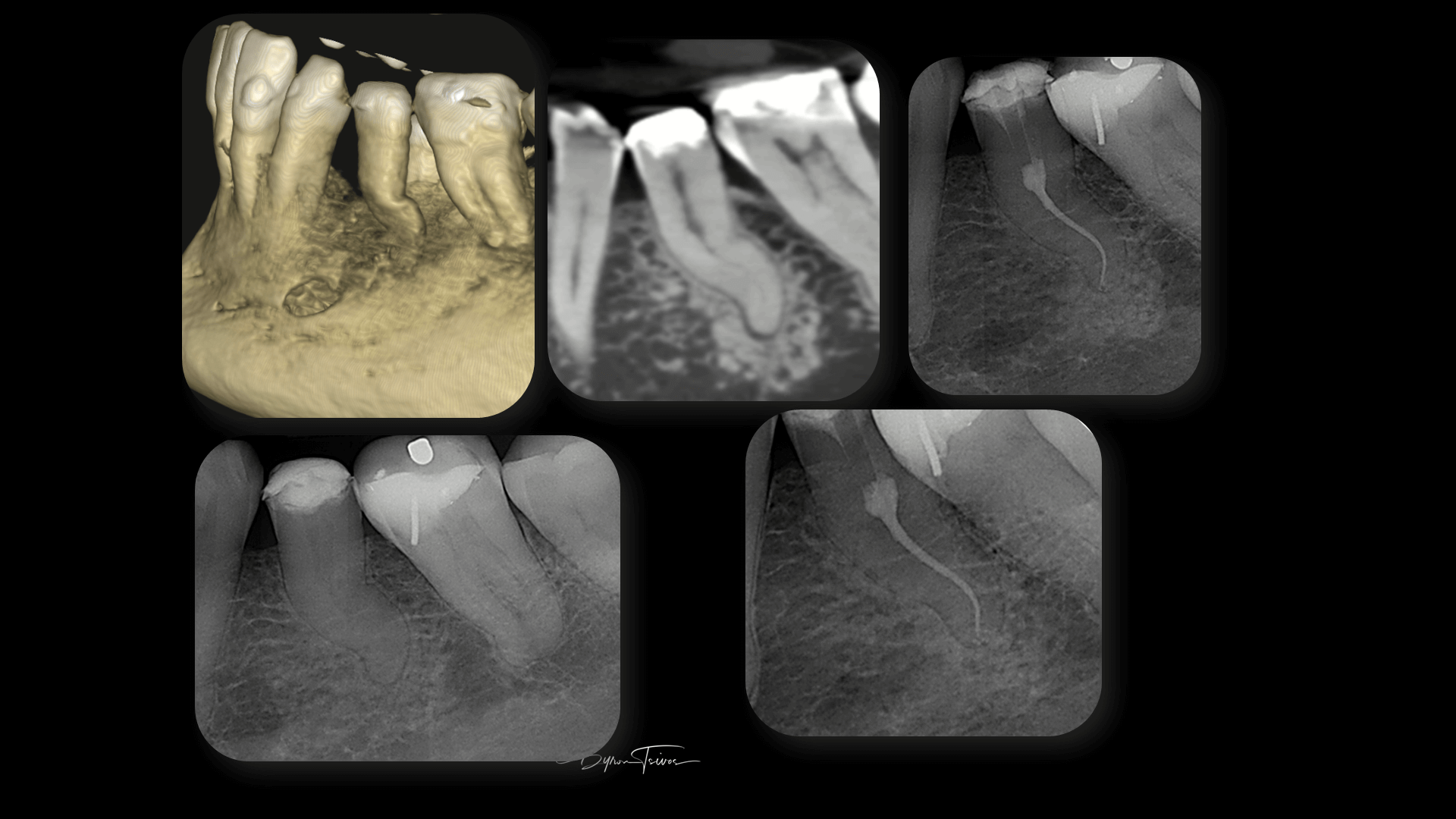 Broken Instrument Removal - Case 6